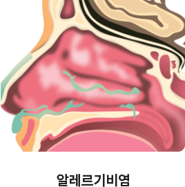 알레르기비염 이미지