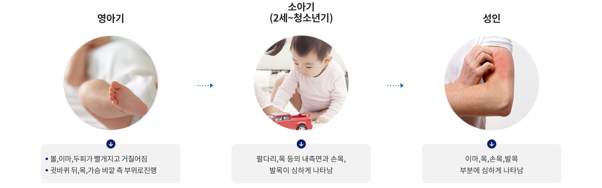 연령에 따른 발생 부위변화